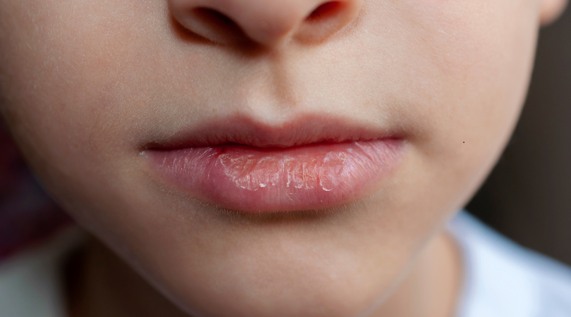 Chapped Lips? Must Have Summer Products - Enviromental Barrier Lip Balm